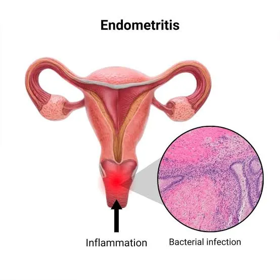 Endometriosis
